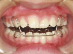 二期分割矯正歯科治療